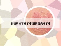副银屑病不痛不痒 副银屑病痒不痒
