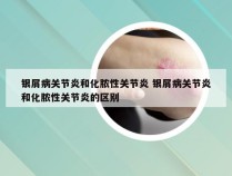银屑病关节炎和化脓性关节炎 银屑病关节炎和化脓性关节炎的区别