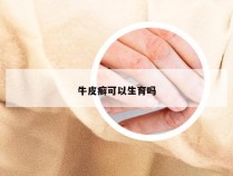 牛皮癣可以生育吗