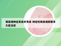 银屑病神经系统并发症 神经性银屑病需要多久能治愈