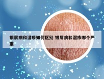 银屑病和湿疹如何区别 银屑病和湿疹哪个严重