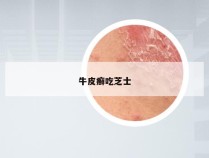 牛皮癣吃芝士
