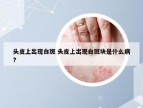 头皮上出现白斑 头皮上出现白斑块是什么病?