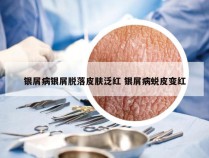 银屑病银屑脱落皮肤泛红 银屑病蜕皮变红