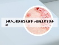 小孩身上很多癣怎么回事 小孩身上长了很多藓