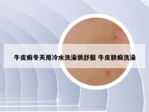 牛皮癣冬天用冷水洗澡很舒服 牛皮肤癣洗澡