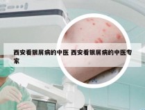 西安看银屑病的中医 西安看银屑病的中医专家