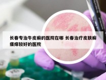 长春专治牛皮癣的医院在哪 长春治疗皮肤癣瘙痒较好的医院