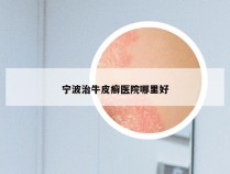 宁波治牛皮癣医院哪里好