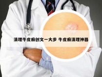 清理牛皮癣创文一大步 牛皮癣清理神器