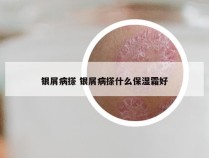 银屑病搽 银屑病搽什么保湿霜好