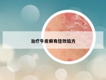 治疗牛皮癣有佳效验方