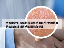 全国最好的治脓包性银屑病的医院 全国最好的治脓包性银屑病的医院在哪里