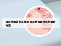 银屑病国外专家共识 银屑病的国外最新治疗方案