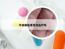 牛皮癣能用发泡治疗吗