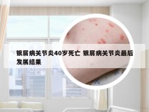 银屑病关节炎40岁死亡 银屑病关节炎最后发展结果