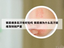 银屑病多出汗有好处吗 银屑病为什么出汗就爆发特别严重