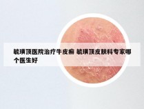 毓璜顶医院治疗牛皮癣 毓璜顶皮肤科专家哪个医生好