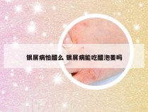 银屑病怕醋么 银屑病能吃醋泡姜吗