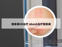 银屑病UB治疗 nbuvb治疗银屑病