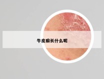 牛皮癣长什么呢