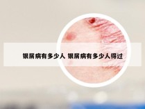 银屑病有多少人 银屑病有多少人得过