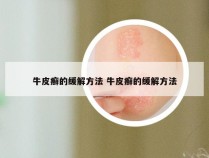 牛皮癣的缓解方法 牛皮癣的缓解方法