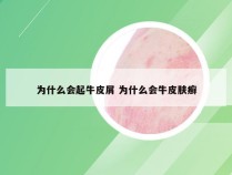 为什么会起牛皮屑 为什么会牛皮肤癣