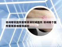 郑州哪家医院看银屑病权威医院 郑州哪个医院看银屑病看得最好