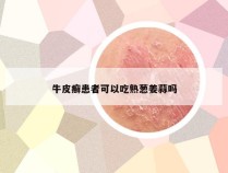 牛皮癣患者可以吃熟葱姜蒜吗