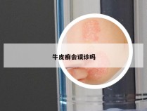 牛皮癣会误诊吗
