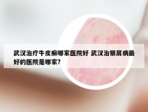 武汉治疗牛皮癣哪家医院好 武汉治银屑病最好的医院是哪家?
