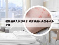 银屑病病人头部手术 银屑病病人头部手术多少钱