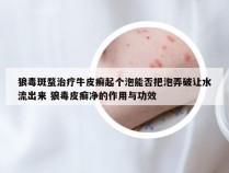 狼毒斑蝥治疗牛皮癣起个泡能否把泡弄破让水流出来 狼毒皮癣净的作用与功效