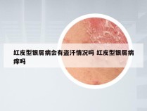 红皮型银屑病会有盗汗情况吗 红皮型银屑病痒吗