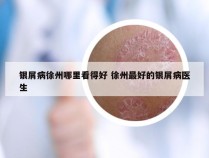 银屑病徐州哪里看得好 徐州最好的银屑病医生