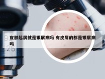 皮肤起屑就是银屑病吗 有皮屑的都是银屑病吗