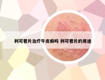利可君片治疗牛皮癣吗 利可君片的用途