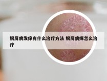 银屑病发痒有什么冶疗方法 银屑病痒怎么治疗
