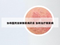 协和医院自制银屑病药膏 协和治疗银屑病