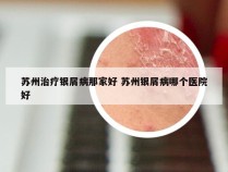 苏州治疗银屑病那家好 苏州银屑病哪个医院好