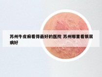 苏州牛皮癣看得最好的医院 苏州哪里看银屑病好