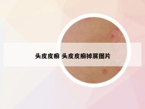 头皮皮癣 头皮皮癣掉屑图片