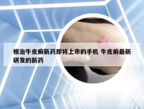 根治牛皮癣新药即将上市的手机 牛皮癣最新研发的新药