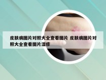 皮肤病图片对照大全查看图片 皮肤病图片对照大全查看图片湿疹