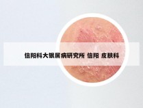 信阳科大银屑病研究所 信阳 皮肤科