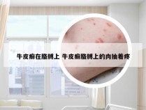 牛皮癣在胳膊上 牛皮癣胳膊上的肉抽着疼