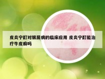 皮炎宁酊对银屑病的临床应用 皮炎宁酊能治疗牛皮癣吗