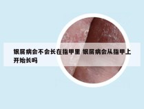 银屑病会不会长在指甲里 银屑病会从指甲上开始长吗