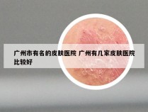 广州市有名的皮肤医院 广州有几家皮肤医院比较好
